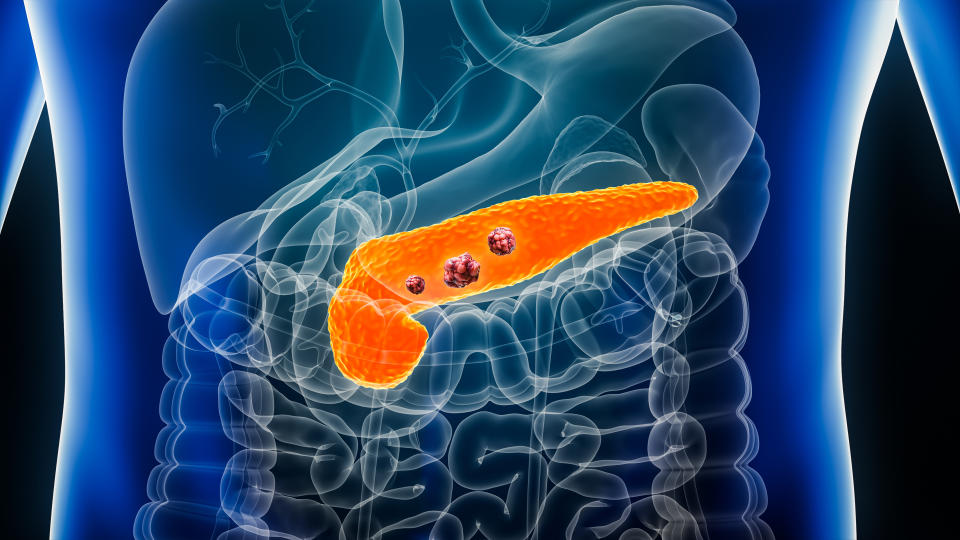 Anatomical illustration showing pancreas with cancerous tumors in the human digestive system