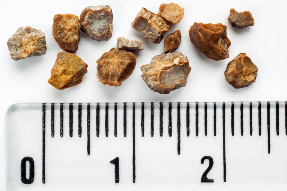Kidney stones are typically smaller or just larger than a peppercorn and come in various colors. There are multiple factors that contribute to forming the stones, including dehydration (Getty Images/iStock)