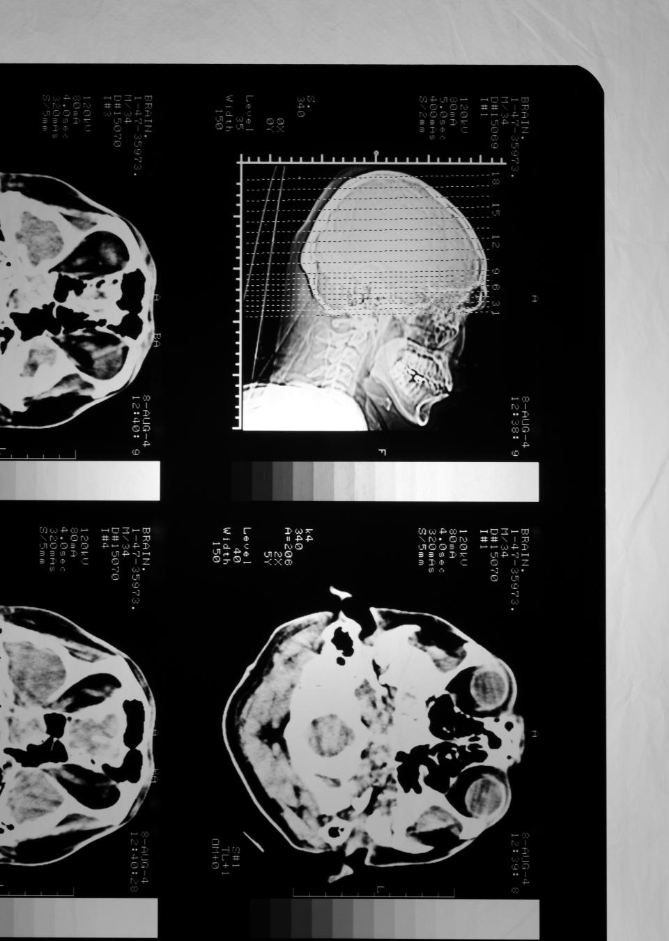 X-ray images showing multiple views of a human skull from different angles