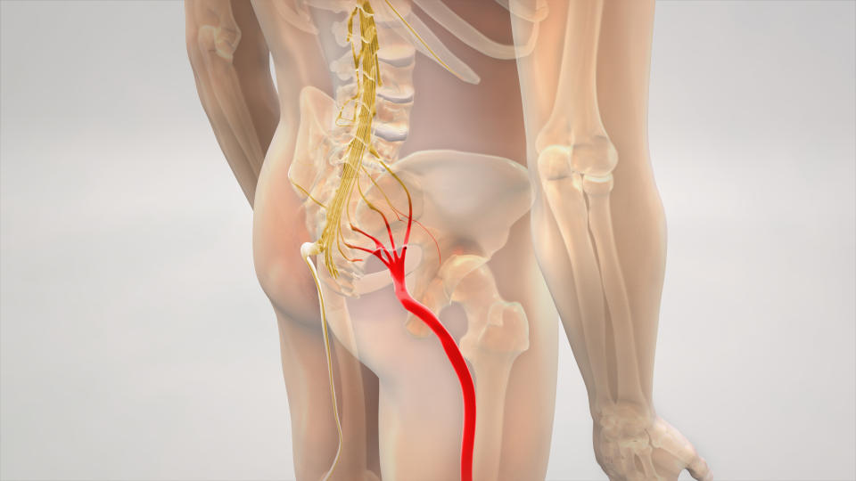 Medical illustration showing the sciatic nerve in the lower back, pelvis, and leg, highlighting its path and connection to the spine