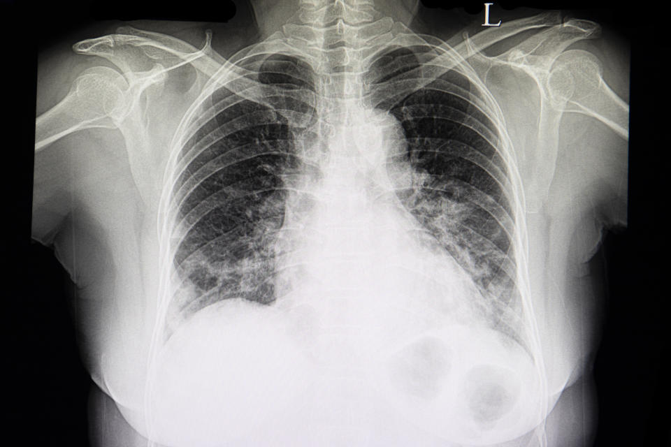 X-ray of a human chest showing lungs, heart, and ribcage in standard medical format